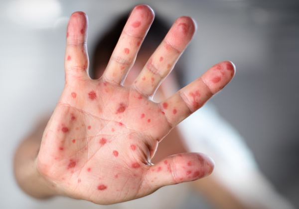 Бангладешда юздан ошиқ бола қизамиқдан вафот этди