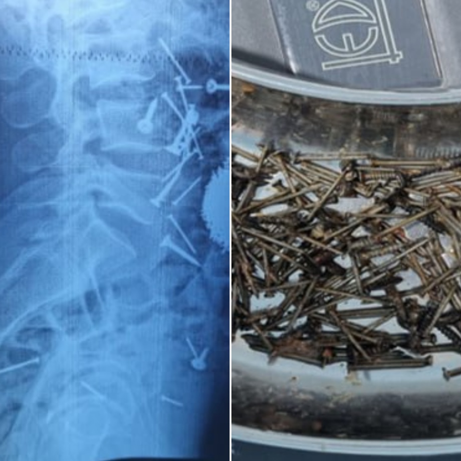 В Самарканде врачи спасли 29-летнего мужчину, проглотившего около 200 граммов гвоздей