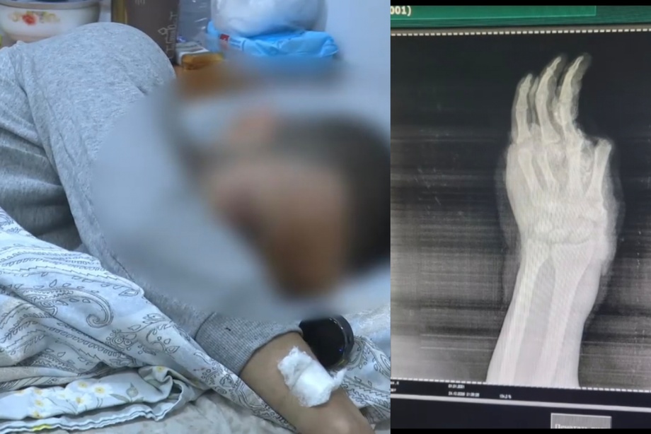 В Ташкенте 24-летнему парню ампутировали кисти рук из-за пиротехники