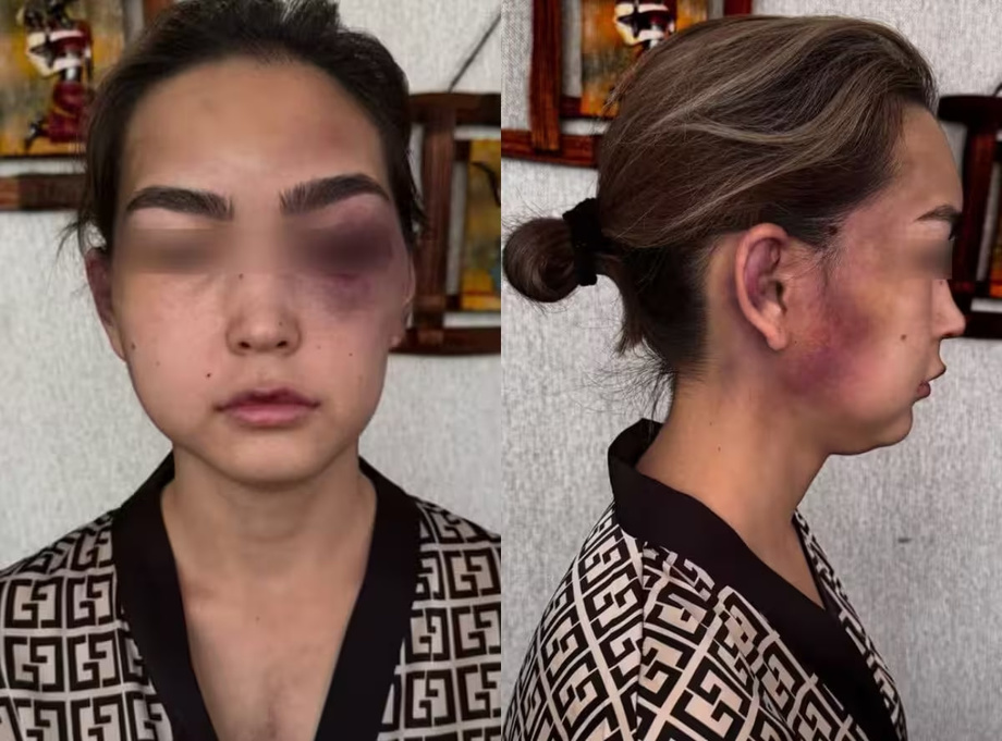 В Сурхандарье мужчина жестоко избил свою жену. По делу начата проверка