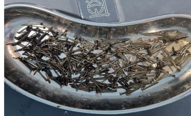 Самарқандда беморнинг қорнидан 200 грамм мих олиб ташланди